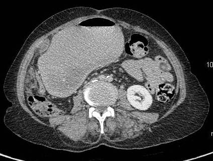 Figure 18: patient with advance carcinoma with discrete nodular peritoneal deposits and gastric outlet obstruction.